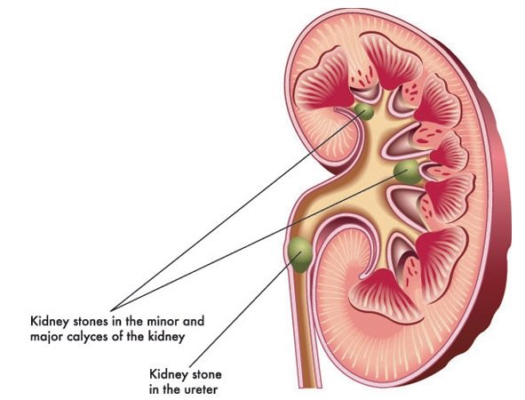 Kidney Stone Remedy