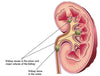 Kidney Stone Remedy